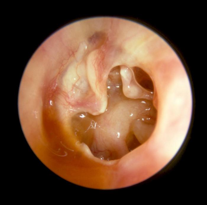 otituxaprichinisimptomiilechenie 07F218D5 - Ушные капли при отите: какие лучше капли в уши при отите для детей и взрослых