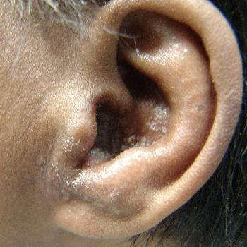 otituxaprichinisimptomiilechenie B70D89C9 - Ушные капли при отите: какие лучше капли в уши при отите для детей и взрослых