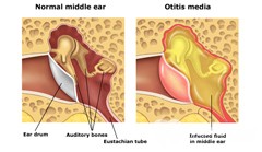 otituxaprichinividisimptomidiagnostikale DD645DB3 - Ушные капли при отите: какие лучше капли в уши при отите для детей и взрослых