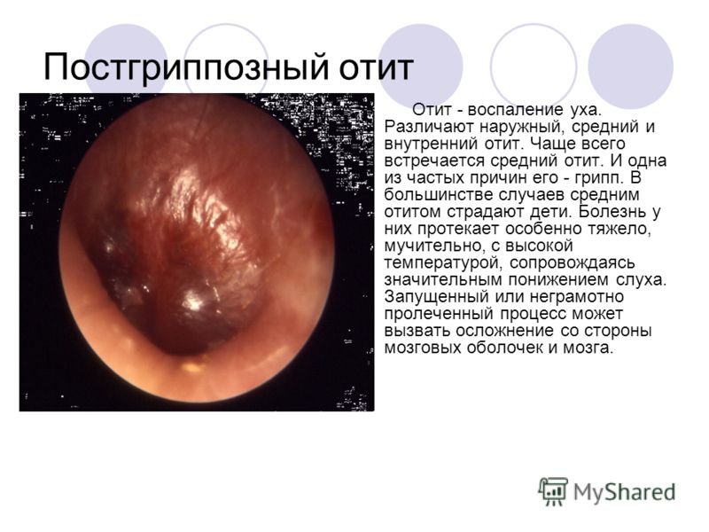 otitvnutrenniyfoto 8BD09C96 - Отит среднего уха: симптомы и лечение, фото