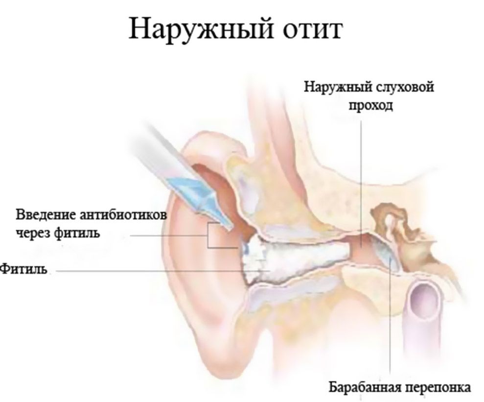 otitvnutrenniyfoto 98C08968 - Отит среднего уха: симптомы и лечение, фото