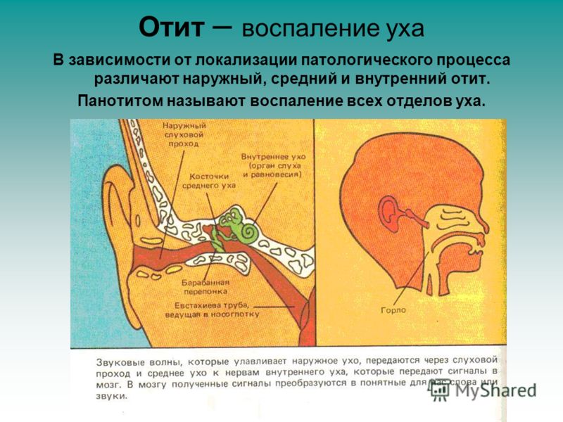 otitvnutrenniyfoto CBC7DAE0 - Отит среднего уха: симптомы и лечение, фото