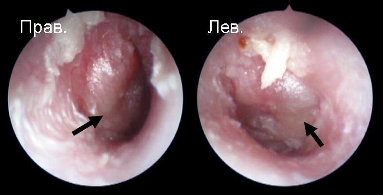otitvnutrenniyfoto DE652527 - Отит среднего уха: симптомы и лечение, фото