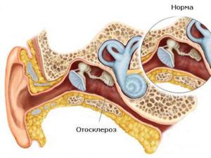 otosklerozsimptomiilechenienarodnimisred D70718C7 - Боль в ушах: почему возникает и как лечить
