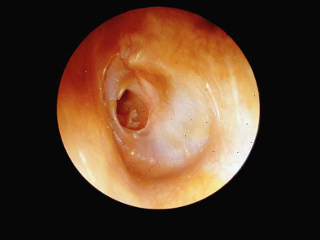 perforativniyotitprichiniprokolaperforat 79645BE8 - Перфоративный отит среднего уха: сиптомы и лечение