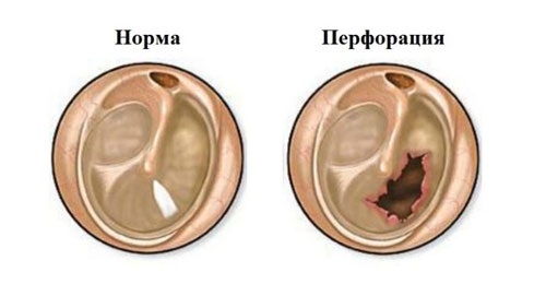 perforatsiyabarabannoypereponkisimptomii 91E73337 - Перфоративный отит среднего уха: сиптомы и лечение