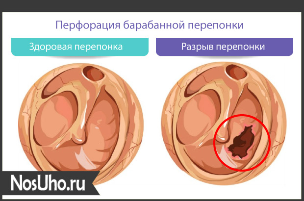perforatsiyabarabannoypereponkisimptomii B554B390 - Cимптомы перфорации барабанной перепонки