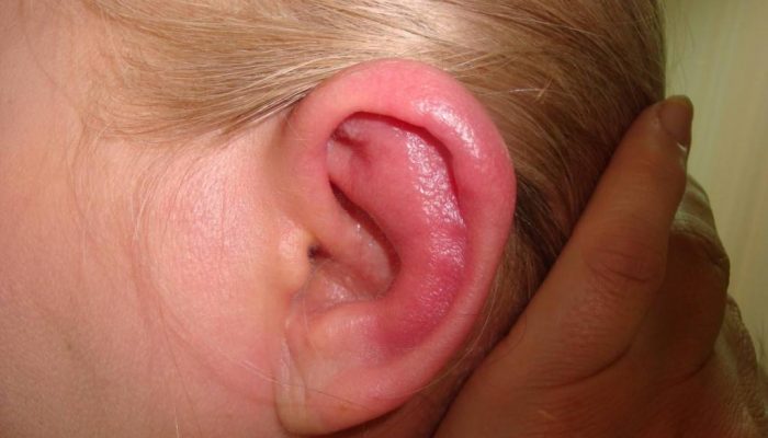 perixondritushnoyrakovinilechenie F93B7510 - Перихондрит ушной раковины: симптомы, лечение, фото