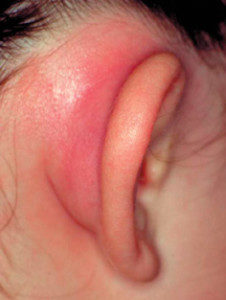 perixondritushnoyrakovinilechenieisimpto B13C461D - Перихондрит ушной раковины: симптомы, лечение, фото