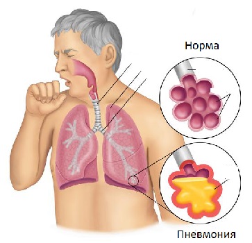 pnevmoniyasimptomilechenieoslozhneniyauv 3AB357E7 - Пневмония симптомы и общие признаки