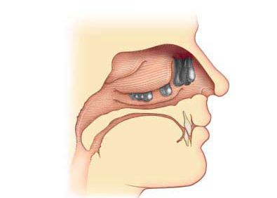 polipivnosulecheniebezoperatsii 0048294B - Полип носа – разрастание слизистой, выступающее в полость или пазуху носа