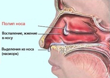 polipivnosuprichinipoyavleniyasimptomile 752C1686 - Полип носа – разрастание слизистой, выступающее в полость или пазуху носа
