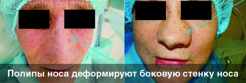 polipivnosuprichinipoyavleniyasimptomile C0D1EF2B - Полип носа – разрастание слизистой, выступающее в полость или пазуху носа