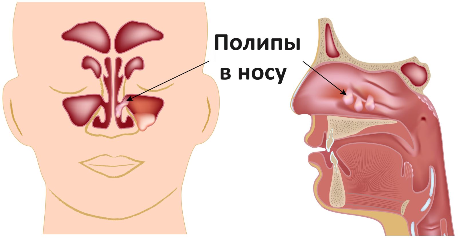 polipivnosuprichinipoyavleniyasimptomile F1756E60 - Полип носа – разрастание слизистой, выступающее в полость или пазуху носа