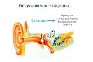 posleotitaostalaszalozhennostuxachtodela 8AB9A35F - Заложенность уха после отита: когда пройдет и что делать?