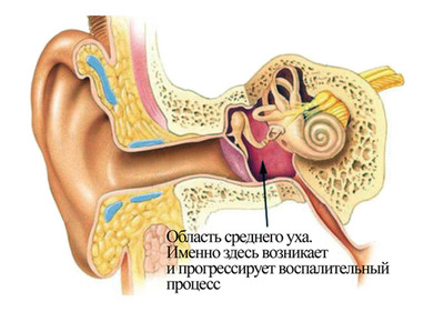posleotitaostalaszalozhennostuxakogdapro A9637E7A - Заложенность уха после отита: когда пройдет и что делать?