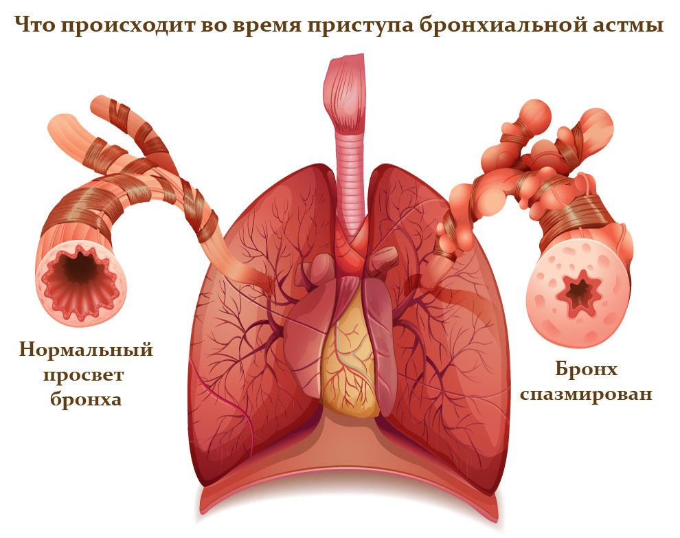 pristupbronxialnoyastmineotlozhnayapomos B4607D68 - Бронхиальная астма — одно из самых встречаемых хронических заболеваний среди населения всей планеты