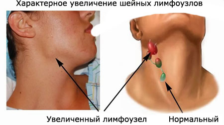 rakgorlaperviepriznakifotolechenieiprogn 85186507 - Шумит в голове и ушах: причины шума, гудения в ушах и гула в голове, лечение