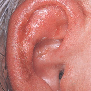 rozhauxalecheniesimptomiifoto 28647244 - Рожистое воспаление уха