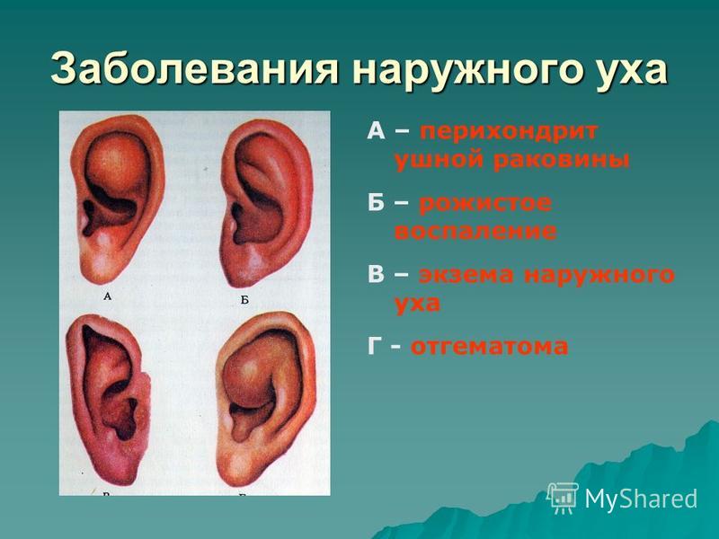 rozhistoevospalenienaruzhnogouxa 60E3889D - Рожистое воспаление уха