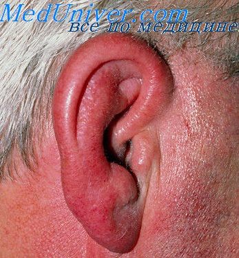 rozhistoevospalenienaruzhnogouxa EFF0D10F - Рожистое воспаление уха