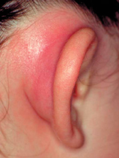 rozhistoevospalenieuxafotosimptomiileche 79821B93 - Рожистое воспаление уха