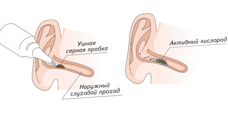 sernayaprobkavuxekakudalitipromitvdomash DB687196 - Основные причины образования пробок в ушах, как убрать