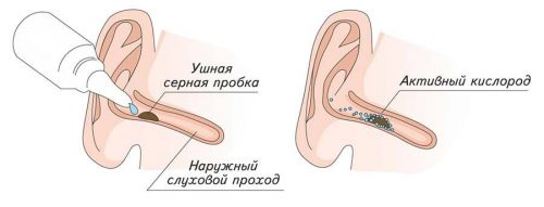 sernieprobkivushaxkakudalitsamostoyateln 8D3DB83E - Что такое серная пробка в ухе и как ее удалить?