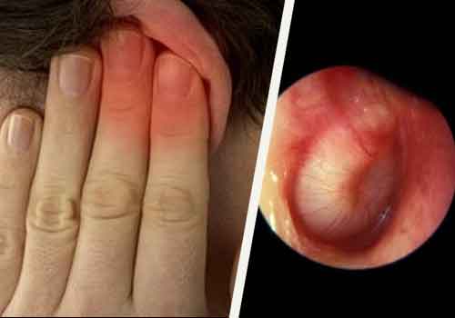shumvushaxposleotitakaklechitshumvushaxp 2A622251 - Шум в ухе после отита, причины методы лечения
