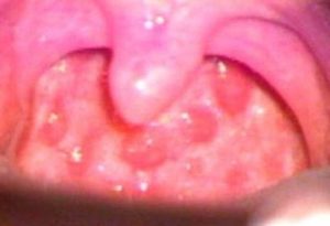simptomiilecheniegranuleznogofaringitaud 29167FFC - Белый налёт на языке у взрослых: причины, лечение, фото