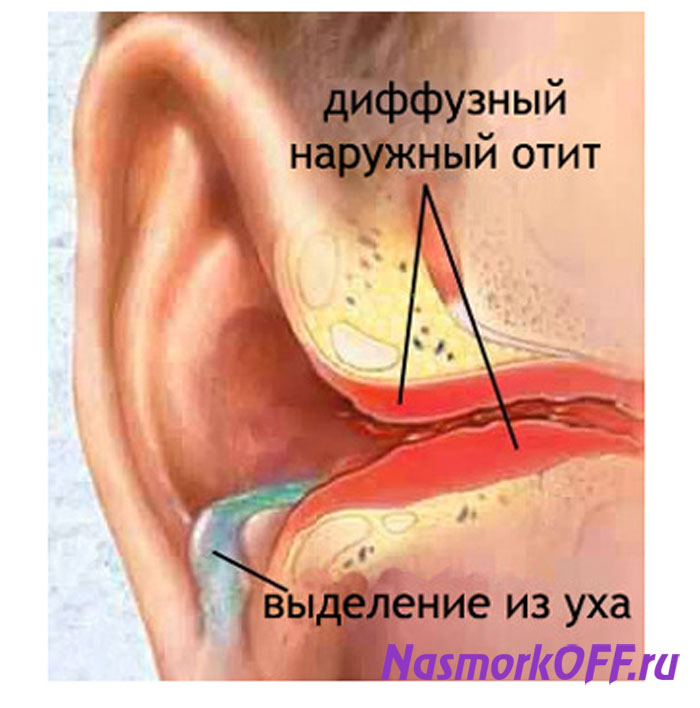 simptomiilechenienaruzhnogodiffuznogooti BBF1D784 - Диффузный отит наружного уха — симптомы и лечение