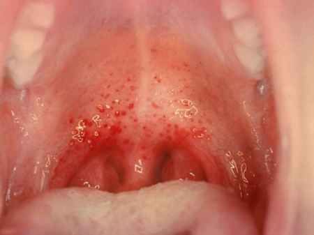 simptomiivsemetodilecheniyafaringitauvzr ADBF5D92 - Полип носа – разрастание слизистой, выступающее в полость или пазуху носа