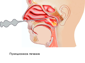 sinusitsimptomiilechenievdomashnixuslovi 7E06FFDC - Хронический синусит – это хроническое воспалительное заболевание одной или нескольких придаточных пазух носа