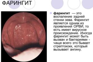 skolkodneylechitsyafaringitportalzdorovy 37BE9722 - Чем отличается ОРЗ от ОРВИ? Острое респираторное заболевание.