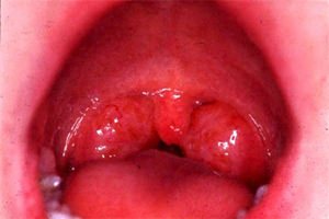 subatroficheskiyfaringitprichinisimptomi 3FF8AD41 - Золотистый стафилококк в горле лечение: пути инфицирования, виды, как лечить