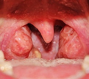 tonzillitfotosimptomiilechenieuvzroslix 577F8AA9 - Орз: первые признаки заболевания, симптомы, отличие орз от орви