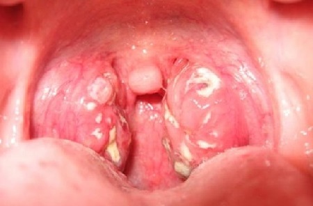 tonzillitsimptomifotolechenie 92F74460 - Ангина у детей и взрослых: симптоматика и как выглядит воспалённая глотка (фото больного горла)