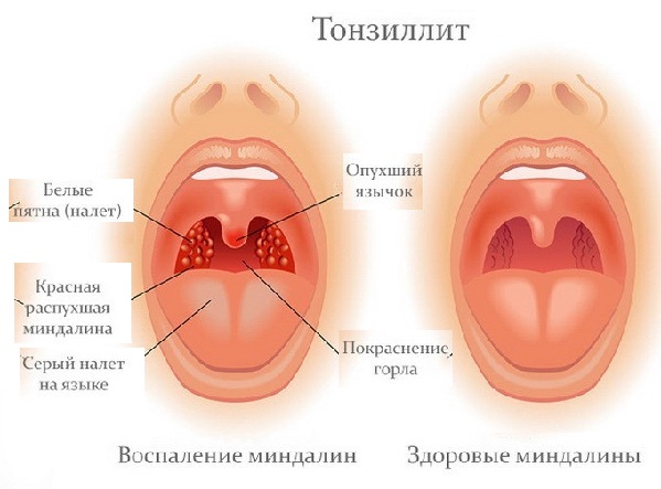 tonzillitsimptomifotolechenie DE529174 - Тонзиллит представляет собой заболевание инфекционно-аллергического характера