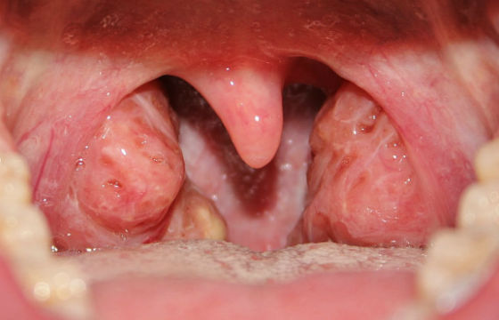tonzillitudeteysimptomilechenievidiosloz 0C116430 - Хронический тонзиллит – это инфекционно-аллергическое воспаление небных миндалин (гланд) у ребенка