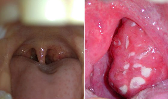tonzillitudeteysimptomilechenievidiosloz B95C191D - Хронический тонзиллит – это инфекционно-аллергическое воспаление небных миндалин (гланд) у ребенка
