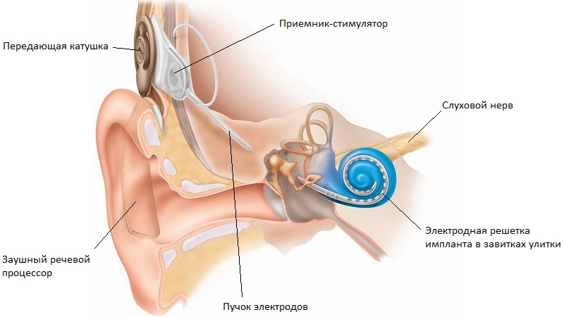 tugouxostkodpomkb10neyrosensornayaisenso 4390D85D - МКБ 10 — Кондуктивная и нейросенсорная потеря слуха (H90)
