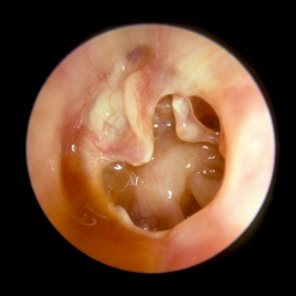 vidiotitovixsimptomiilechenieserozniygno 29B34191 - Отит среднего уха: симптомы и лечение, фото