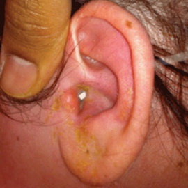 vidiotitovixsimptomiilechenieserozniygno 2E76779C - Отит среднего уха: симптомы и лечение, фото