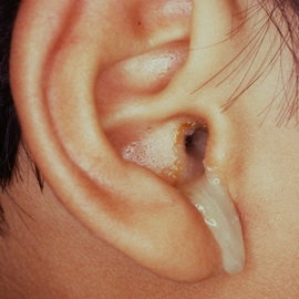 vidiotitovixsimptomiilechenieserozniygno 82C0E4A1 - Отит среднего уха: симптомы и лечение, фото