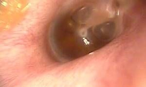 vnutrenniyotitsimptomiilechenie 9F74F170 - Внутренний отит уха: симптомы, лечение