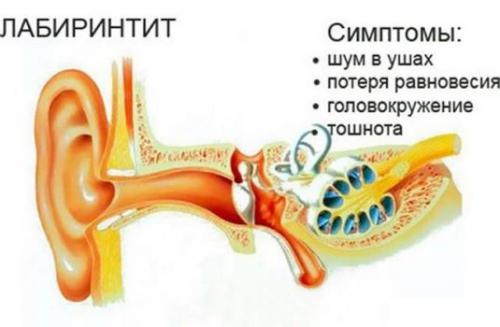 vnutrenniyotitsimptomivospaleniyavnutren F4717DFF - Внутренний отит уха: симптомы, лечение