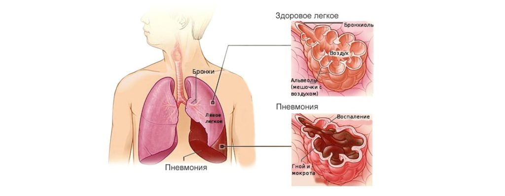 vospalenielegkixuvzroslix5glavnixsimptom 065627B2 - Пневмонией называют инфекционное заболевание лёгких