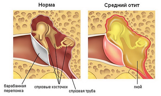 vospaleniesrednegouxaetaproblemamozhetpo 3FD6B3E1 - Воспаление среднего уха у взрослых – причины, симптомы и лечение воспаления среднего уха