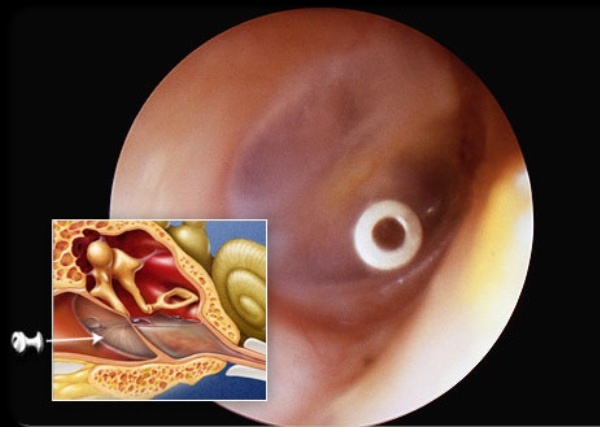 vospaleniesrednegouxasimptomiilecheniech 1D52640F - Воспаление среднего уха у взрослых – причины, симптомы и лечение воспаления среднего уха