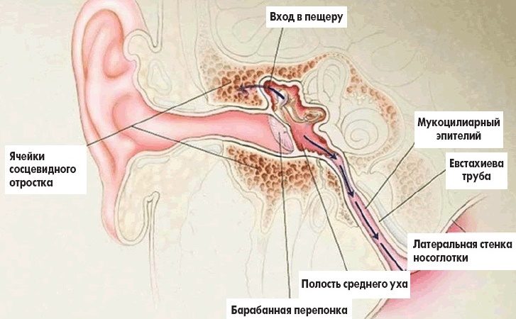 vospaleniesrednegouxasimptomiilecheniech B71C941E - Воспаление среднего уха у взрослых – причины, симптомы и лечение воспаления среднего уха